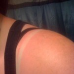 Summer Sunburn Remedies